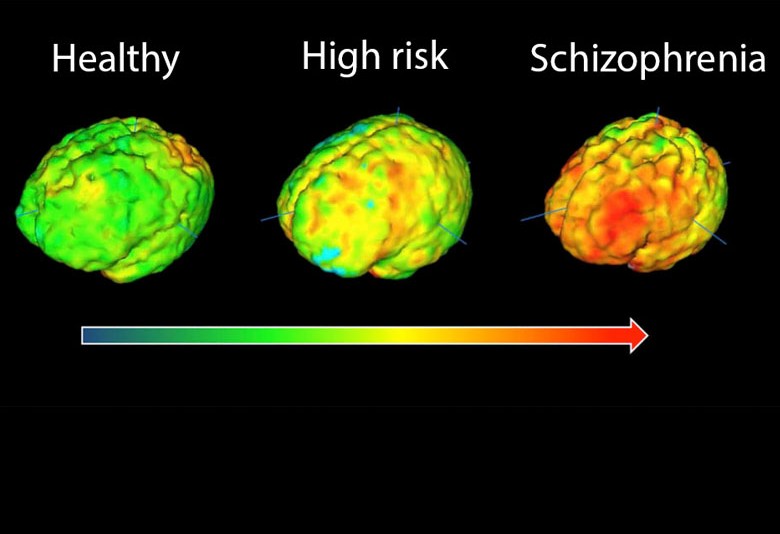 Inflammation in schizophrenia
