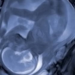 First 3D MRI Scans of Unborn Babies