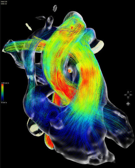 4D MRI image of blood flowing through the heart