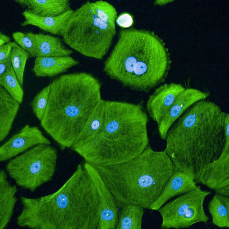 Shows breast cancer cells treated for 7 days