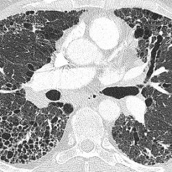 CT scan from an individual with IPF at diagnosis