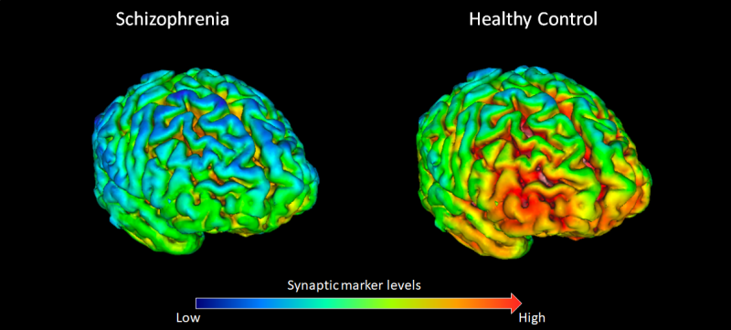 Synaptic Loss In Schizophrenia Confirmed Using Live Imaging Tool