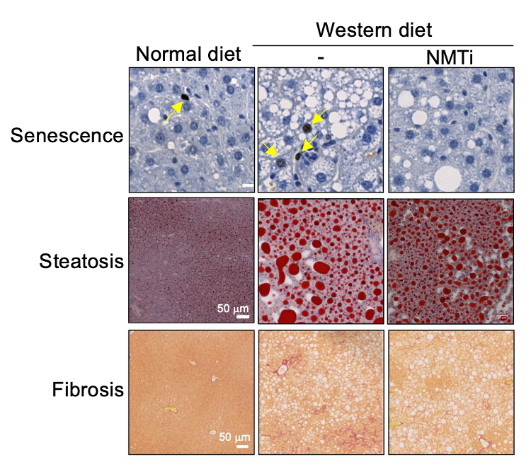Liver sections showing how the treatment with NMTi reduced cellular senescence, the accumulation of fat (steatosis) and fibrosis in mice fed with Western diet (a model for non-alcoholic steatohepatitis)