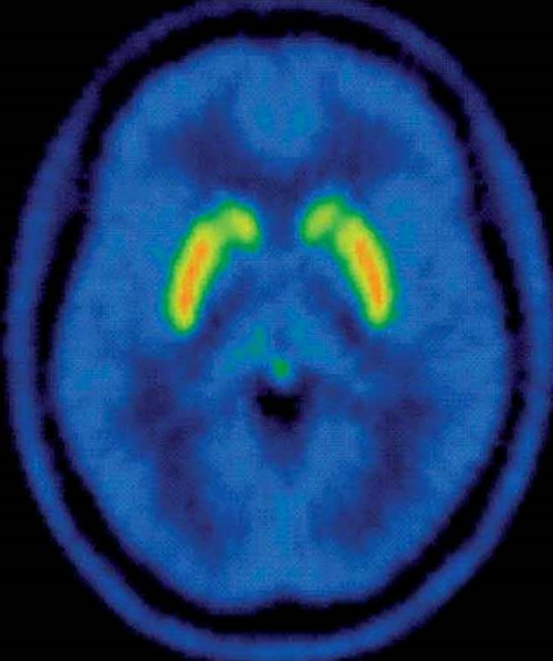 PET brain scan shows dopamine (orange)