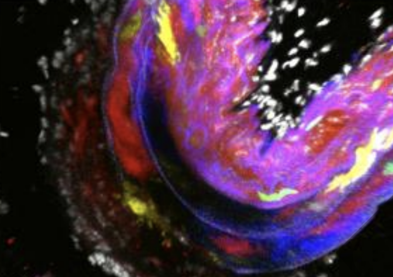 Primed Smooth Muscle Cells Act As first Responders In Vascular Disease
