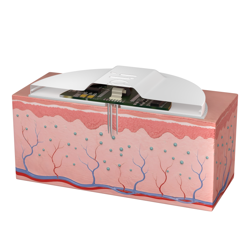 Cross section view of the Impli microneedle device, highlighting the microneedle depth, sensing in the interstitial fluid transdermally
