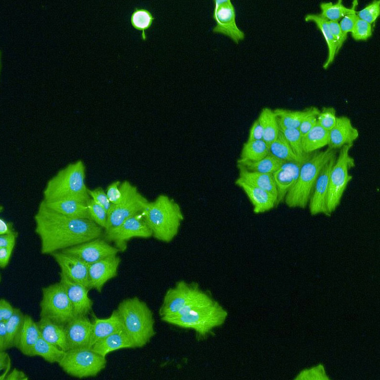 Shows breast cancer cells untreated