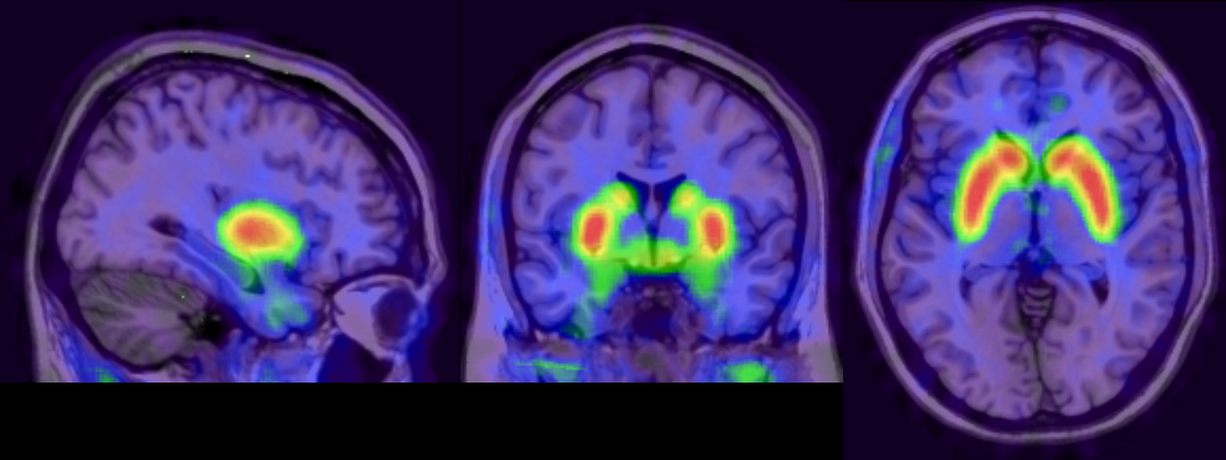 A rundown of TAAR1 as a potential drug target for schizophrenia